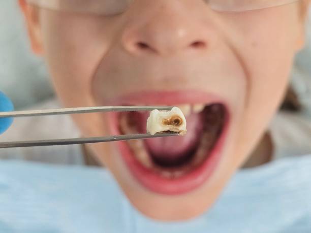 Best Broken or Cracked Tooth Emergency Dentist in Center Line, MI